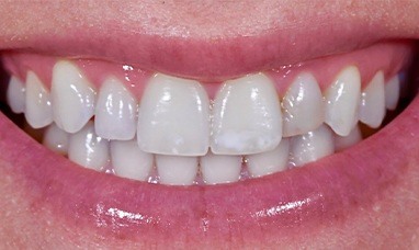 Teeth with bright white spots before porcelain veneers