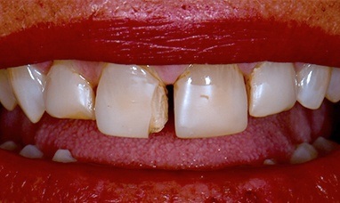 Large gap between teeth and damaged top tooth