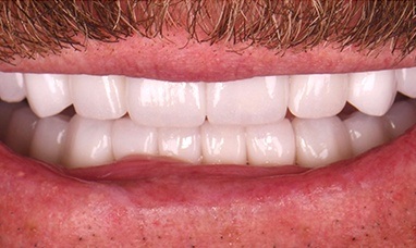 Flawless smile after bottom row of teeth was repaired with dental crown restorations