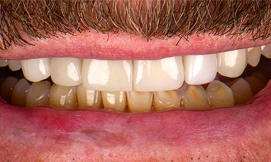 Damaged and discolored lower teeth before porcelain dental crown restorations
