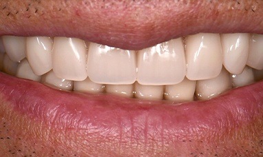Gorgeous smile after porcelain veneer and dental crown restorations