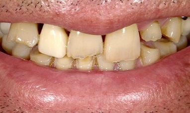 Severely worn and damaged smile before porcelain veneers and dental crown restorations