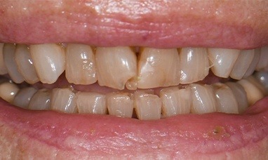 Worn and damaged smile before dental restoration