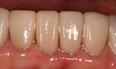 Smile with repaired porcelain veneers on lower teeth