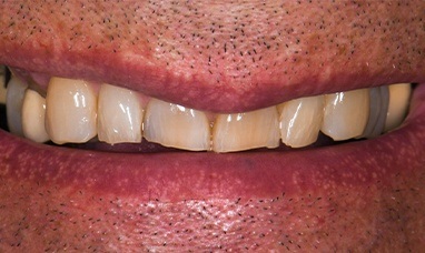 Worn and damaged smile before full mouth reconstruction