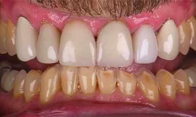 Damaged and discolored lower teeth before restoration