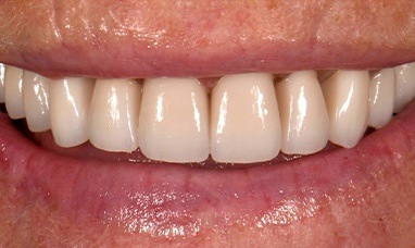 Picture perfect smile after crown lengthening and porcelain restorations