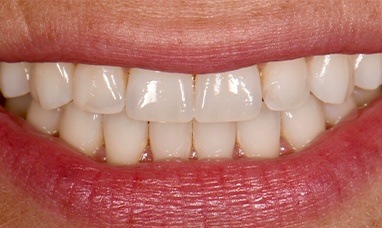 Smile with imperfections before porcelain veneers