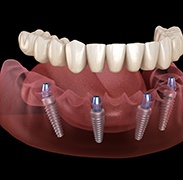 A 3D illustration of All-on-4 dentures