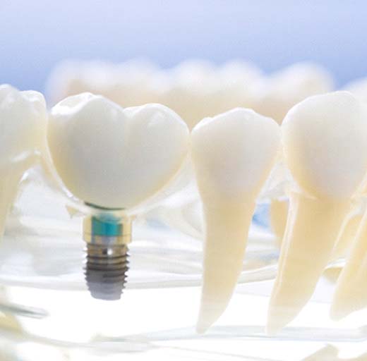 Closeup of dental implants in Estero on model jaw