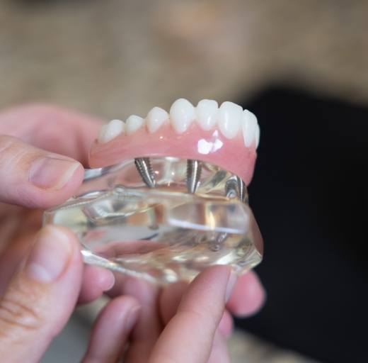 Model of dental implant supported denture