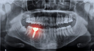 Highlighted X-ray of dental implant failure in Bonita Springs