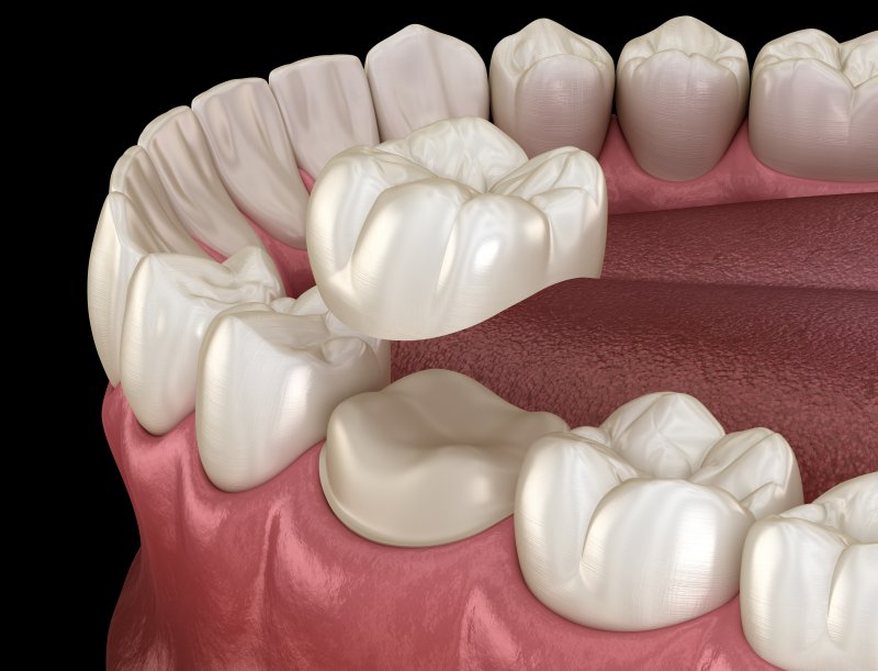 A 3D illustration of a dental crown