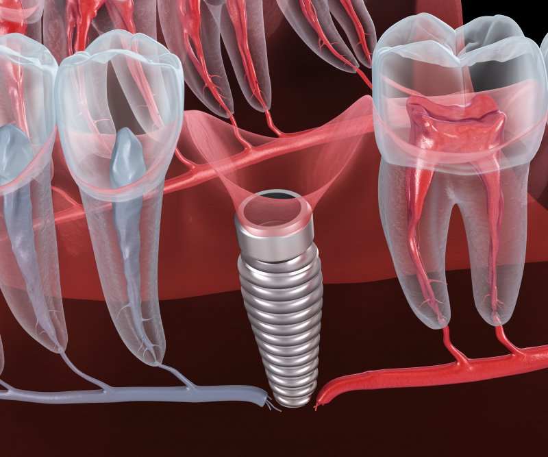 a failed dental implant